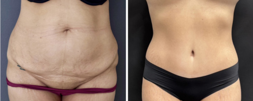 before-after-photo-abdominoplasty-nyc-28