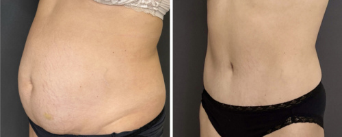 before-after-photo-abdominoplasty-nyc-29