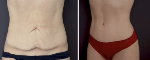 before-after-photo-abdominoplasty-plastic-surgery-nyc-30