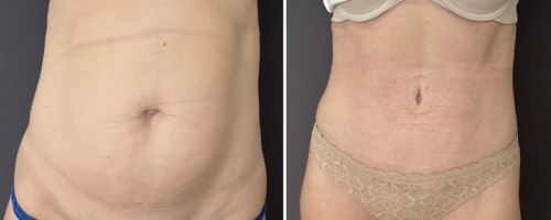 before-after-photo-abdominoplasty-plastic-surgery-nyc-31