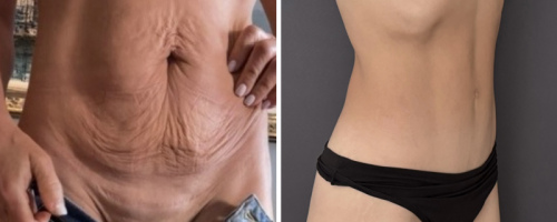 before-after-photo-abdominoplasty-plastic-surgery-nyc-32