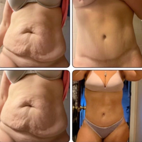 before-after-photo-abdominoplasty-plastic-surgery-nyc-34