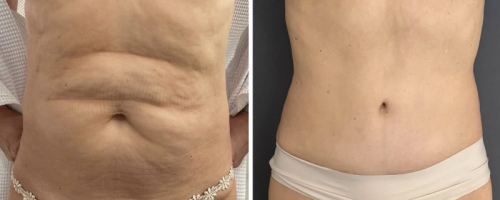 before-after-photo-abdominoplasty-plastic-surgery-nyc-35