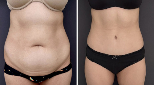 before-after-photo-abdominoplasty-plastic-surgery-nyc-37