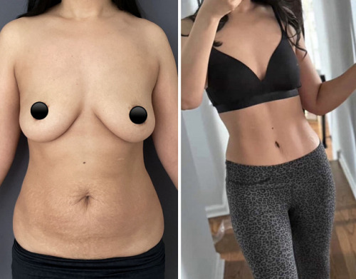 before-after-photo-abdominoplasty-plastic-surgery-nyc-38