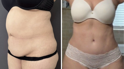 before-after-photo-abdominoplasty-plastic-surgery-nyc-39