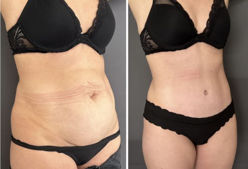 before-after-photo-abdominoplasty-plastic-surgery-nyc-40