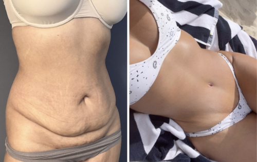 before-after-photo-abdominoplasty-plastic-surgery-nyc-41