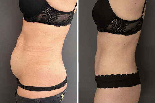 before-after-photo-abdominoplasty-plastic-surgery-nyc-43