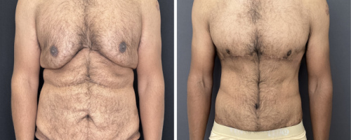 before-after-photo-gynecomastia-abdominoplasty-plastic-surgery-nyc-1