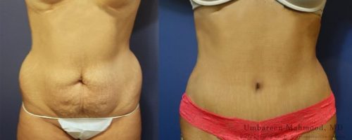 tummy-tuck-before-after-11