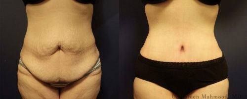 tummy-tuck-before-after-14