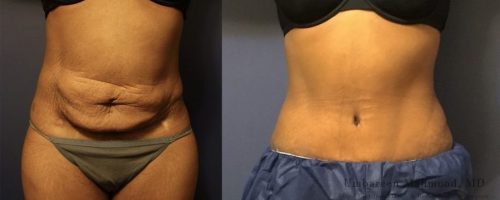 tummy-tuck-before-after-15