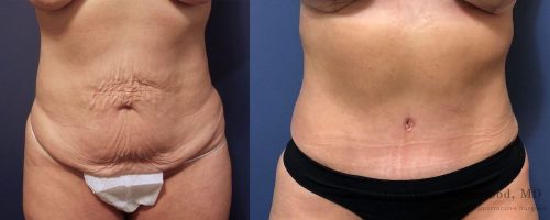 tummy-tuck-before-after-17