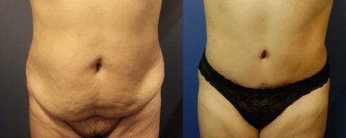 tummy-tuck-before-after-19