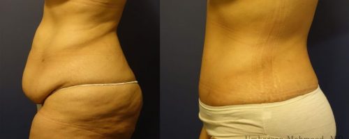 tummy-tuck-before-after-2