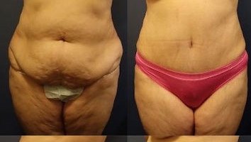 tummy-tuck-before-after-21