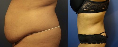 tummy-tuck-before-after-23