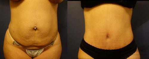 tummy-tuck-before-after-26