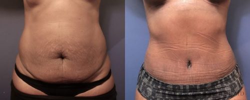 tummy-tuck-before-after-29