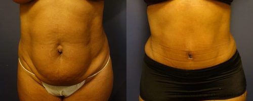 tummy-tuck-before-after-30