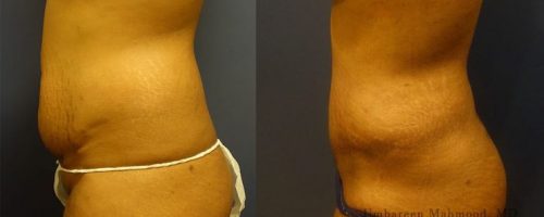 tummy-tuck-before-after-31