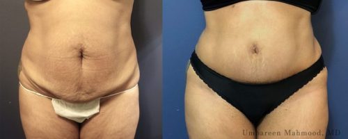tummy-tuck-before-after-32