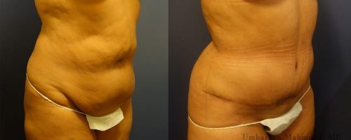 tummy-tuck-before-after-5