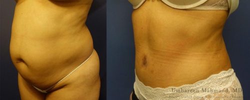 tummy-tuck-before-after-6