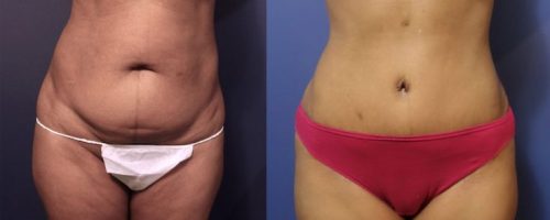 tummy-tuck-before-after-7