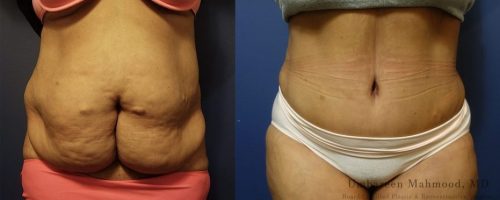 tummy-tuck-before-after-8