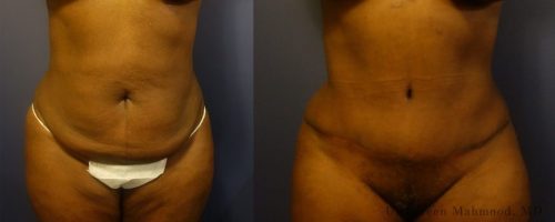 tummy-tuck-before-after-9
