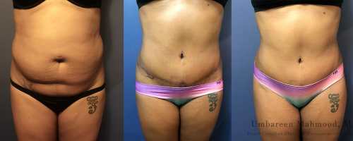 tummy-tuck-before-after-front