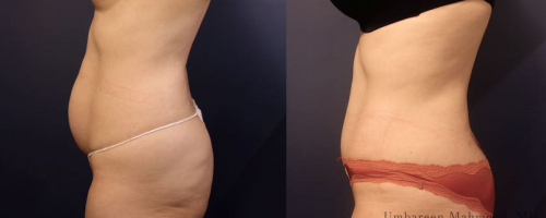 tummy-tuck-before-after-profile-2