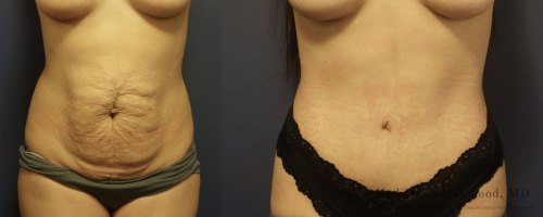 tummy-tuck-before-after