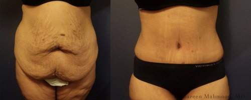tummy-tuck-vs-front