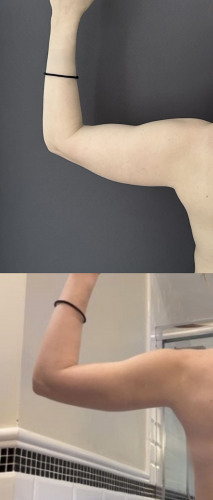 3_Before-After-liposuction-arms-female-9