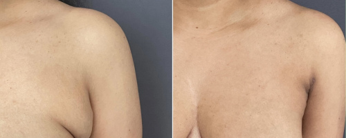 Arm-liposuction-Axillary-before-and-after-photo-032723-1
