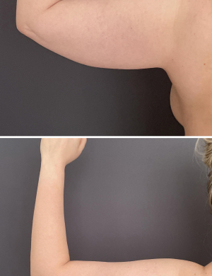 Arm-liposuction-before-and-after-photo-032723-2