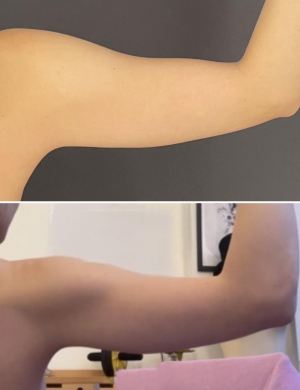 Arm-liposuction-before-and-after-photo-032723-3
