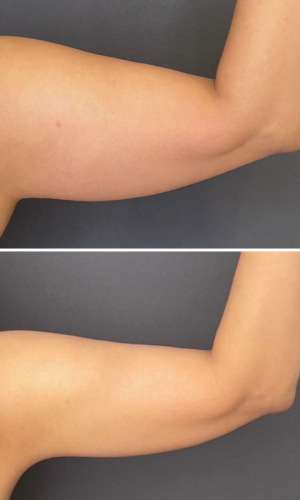 Before-After-Liposuction-arms-2