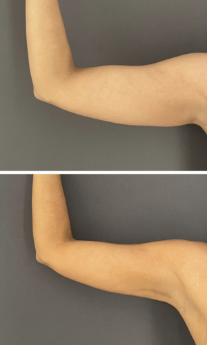 Before-After-Liposuction-arms-3