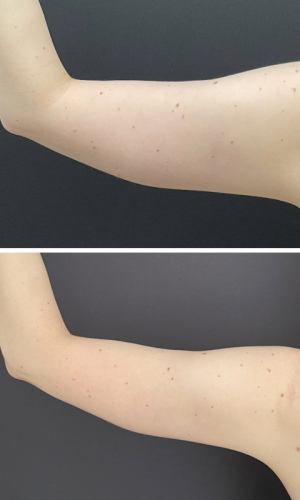 Before-After-Liposuction-arms-4