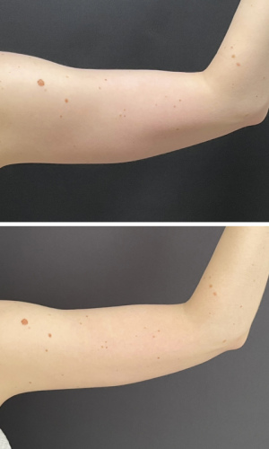 Before-After-Liposuction-arms-5