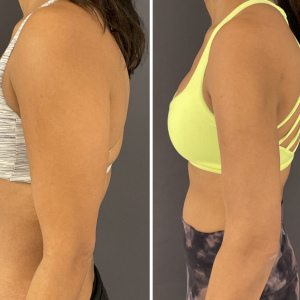 Before-After-Liposuction-arms-6