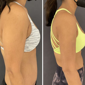 Before-After-Liposuction-arms-7