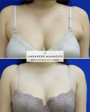 Before-After-Liposuction-arms-8