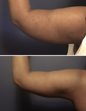 Before-After-Liposuction-arms