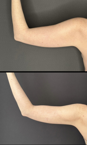 Before-After-liposuction-arms-female-8