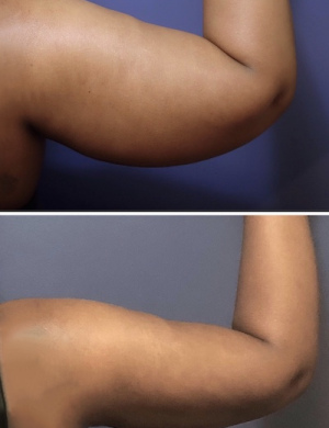 Before-After-liposuction-arms-female